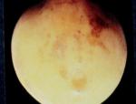 Methyl Bromide Injury (2)